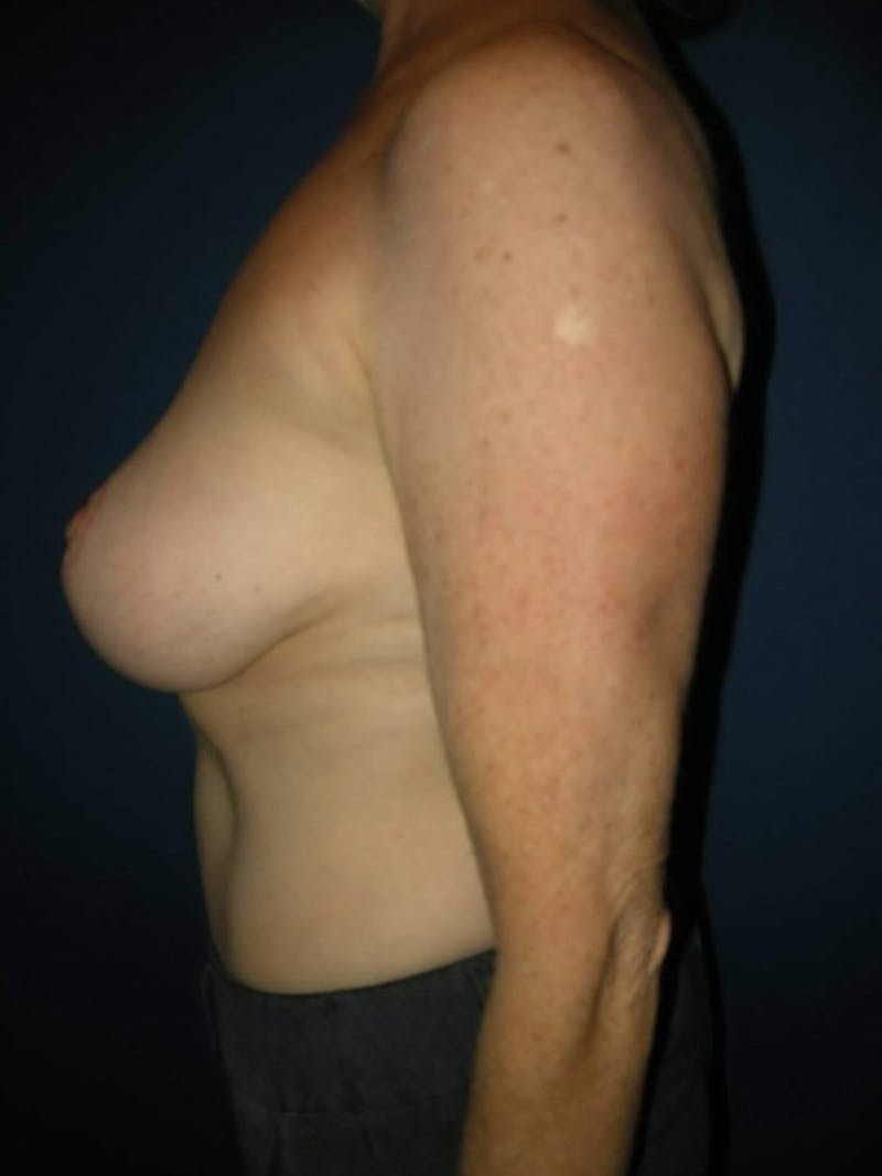 Breast Revision by Dr. Haydon Before & After Gallery - Patient 55455218 - Image 4