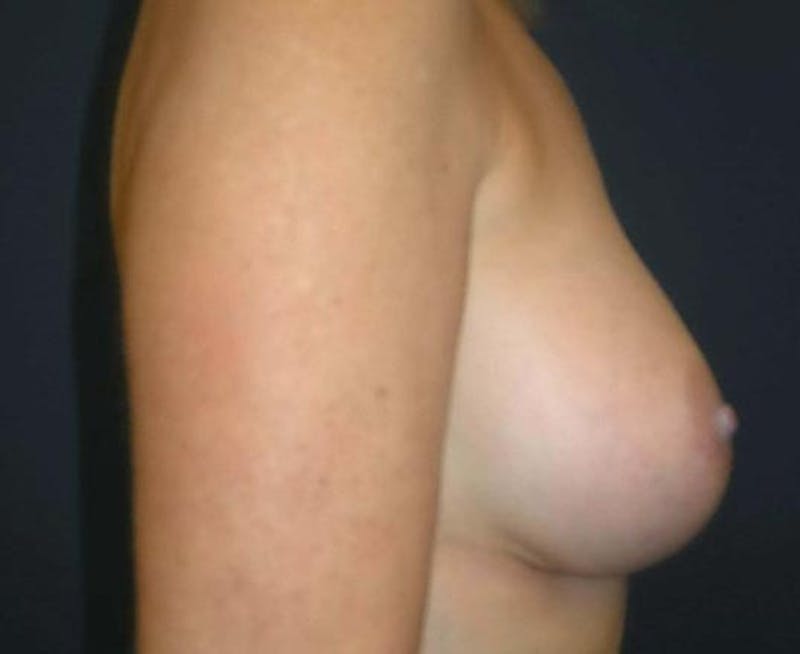 Breast Revision by Dr. Haydon Before & After Gallery - Patient 55455223 - Image 3