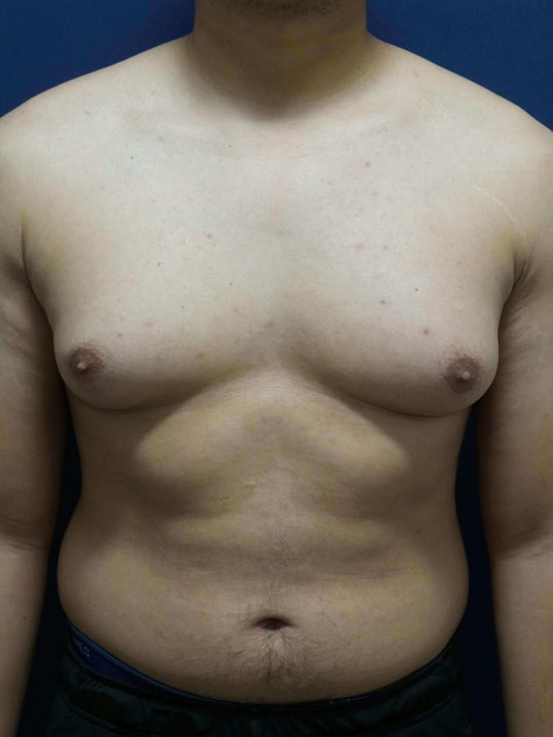Gynecomastia by Dr. Haydon Before & After Gallery - Patient 55455227 - Image 1
