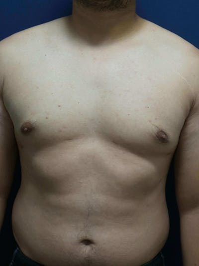 Gynecomastia by Dr. Haydon Before & After Gallery - Patient 55455227 - Image 2