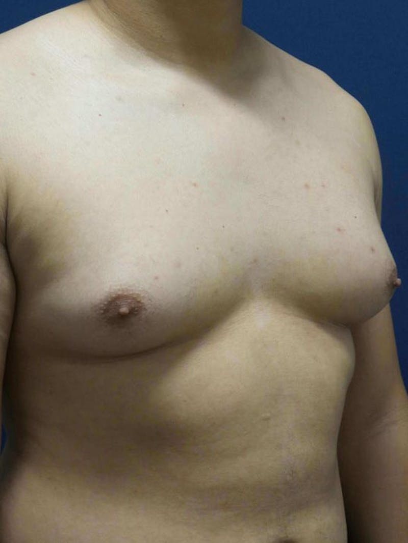Gynecomastia by Dr. Haydon Before & After Gallery - Patient 55455227 - Image 3