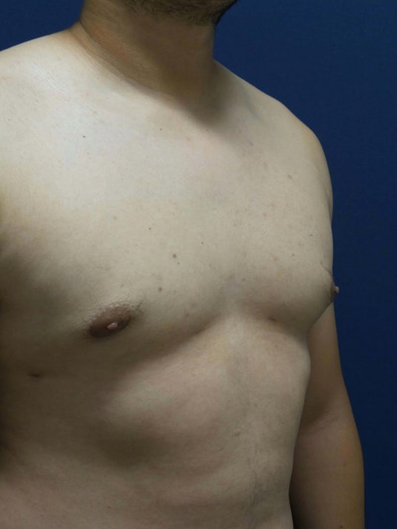 Gynecomastia by Dr. Haydon Before & After Gallery - Patient 55455227 - Image 4