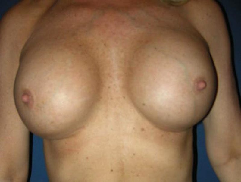 Breast Revision by Dr. Haydon Before & After Gallery - Patient 55455229 - Image 2