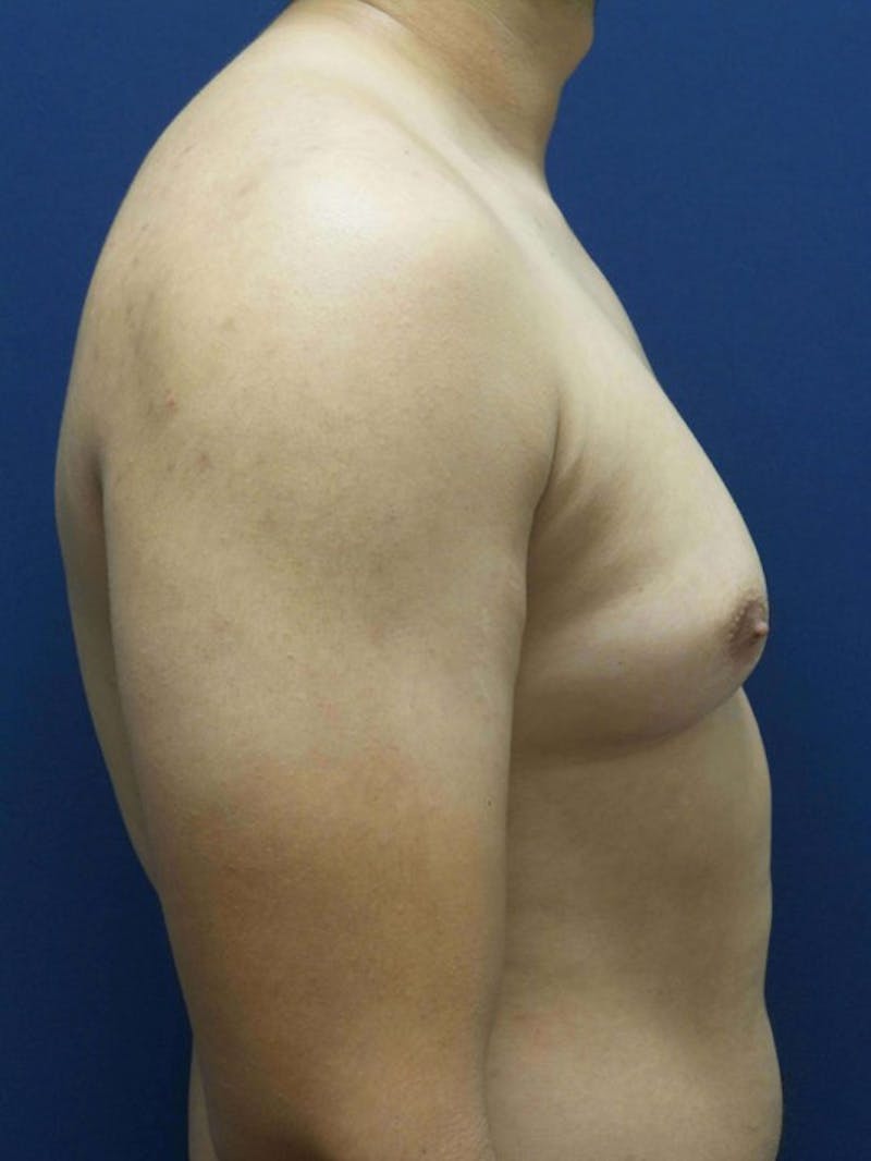 Gynecomastia by Dr. Haydon Before & After Gallery - Patient 55455227 - Image 5