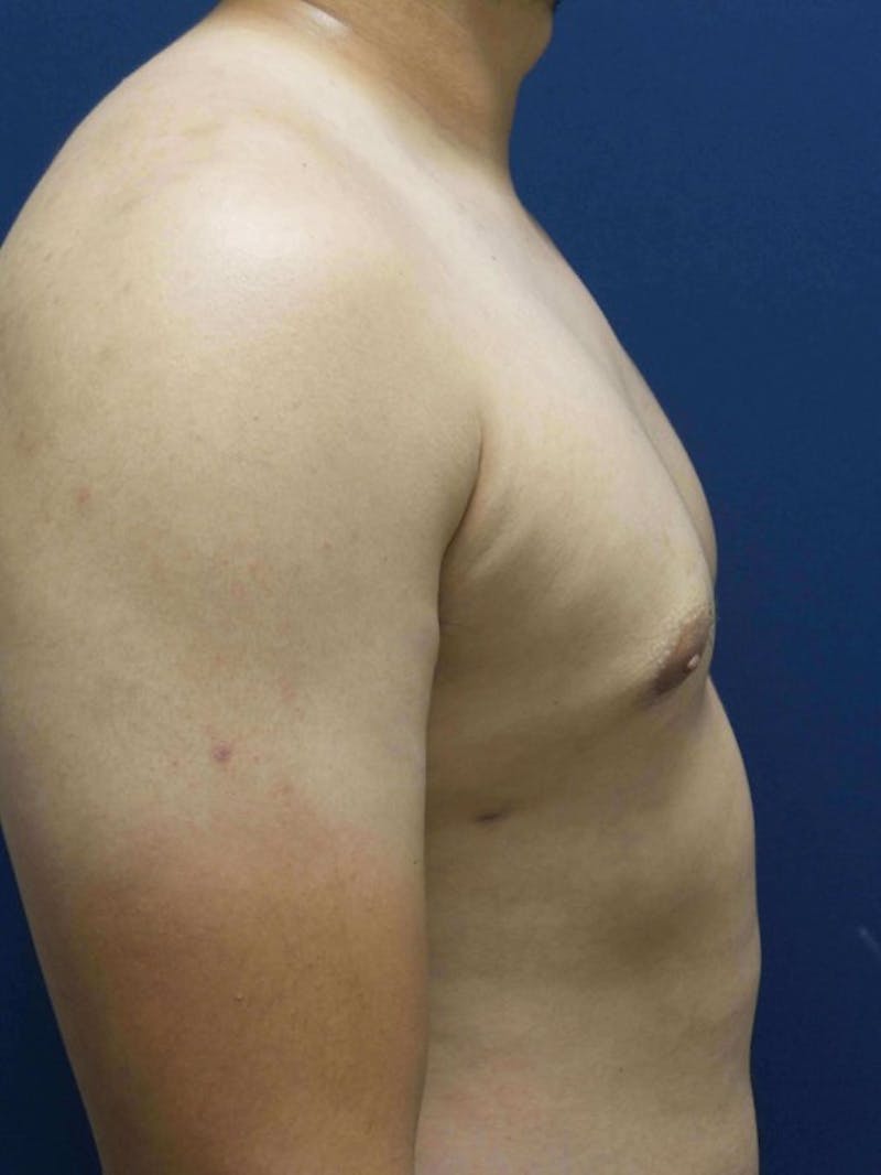 Gynecomastia by Dr. Haydon Before & After Gallery - Patient 55455227 - Image 6