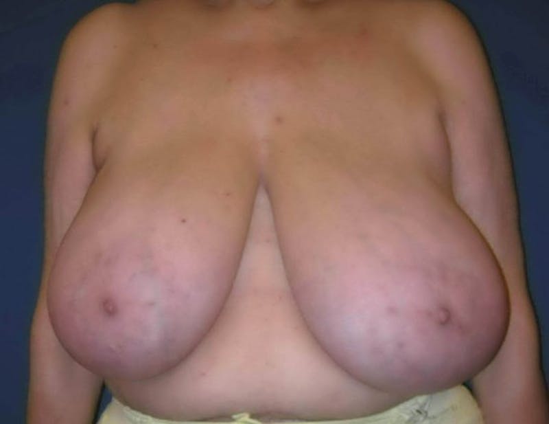 Breast Reduction by Dr. Haydon Before & After Gallery - Patient 55455230 - Image 1