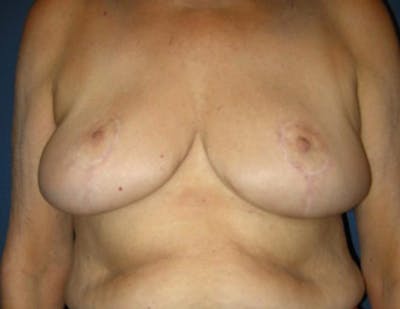Breast Reduction by Dr. Haydon Gallery - Patient 55455230 - Image 2
