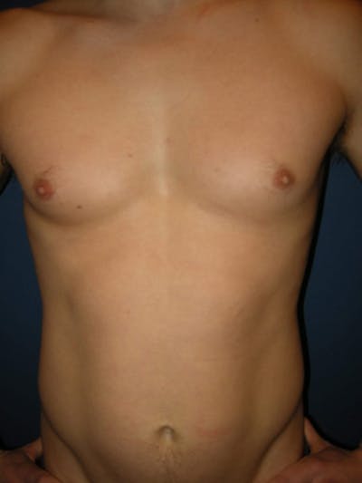 Gynecomastia by Dr. Haydon Before & After Gallery - Patient 55455232 - Image 1