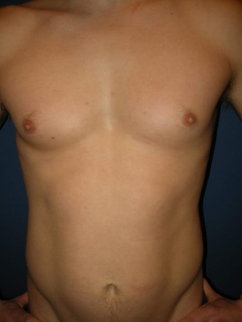 Gynecomastia by Dr. Haydon Before & After Gallery - Patient 55455232 - Image 1