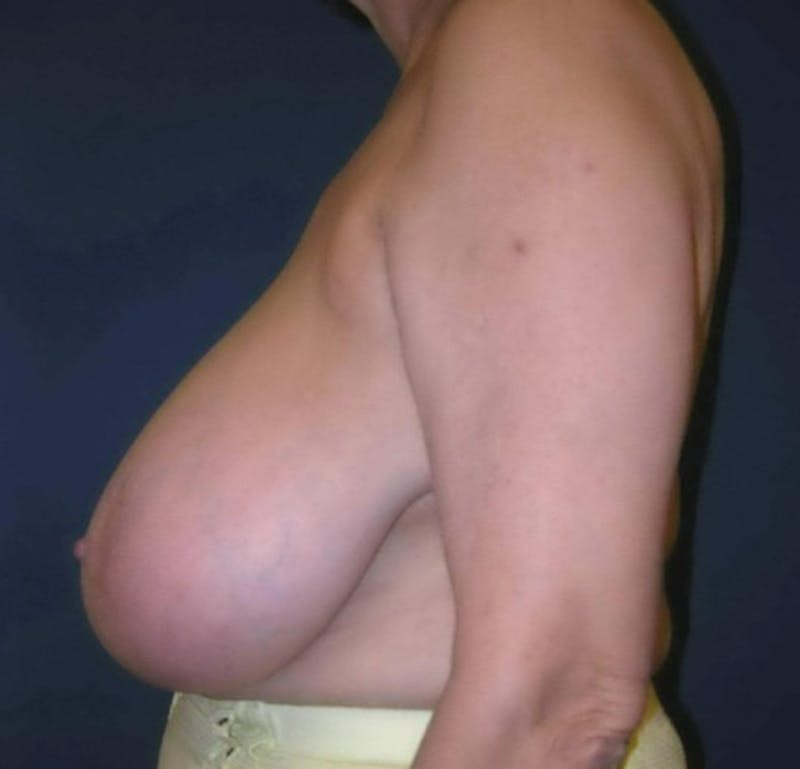 Breast Reduction by Dr. Haydon Before & After Gallery - Patient 55455230 - Image 3