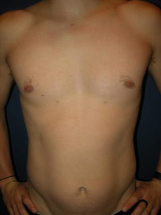 Gynecomastia by Dr. Haydon Before & After Gallery - Patient 55455232 - Image 2