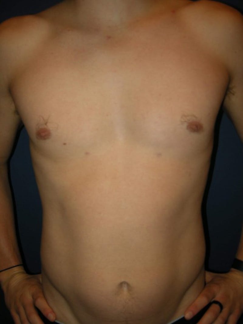 Gynecomastia by Dr. Haydon Before & After Gallery - Patient 55455232 - Image 2
