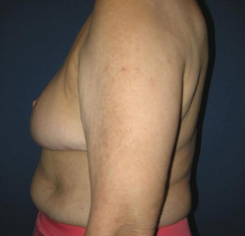 Breast Reduction by Dr. Haydon Before & After Gallery - Patient 55455230 - Image 4