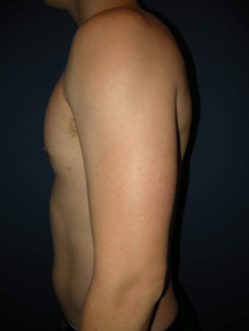 Gynecomastia by Dr. Haydon Before & After Gallery - Patient 55455232 - Image 3