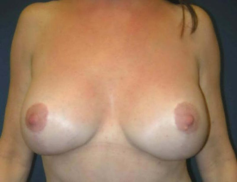 Breast Revision by Dr. Haydon Gallery - Patient 55455234 - Image 2