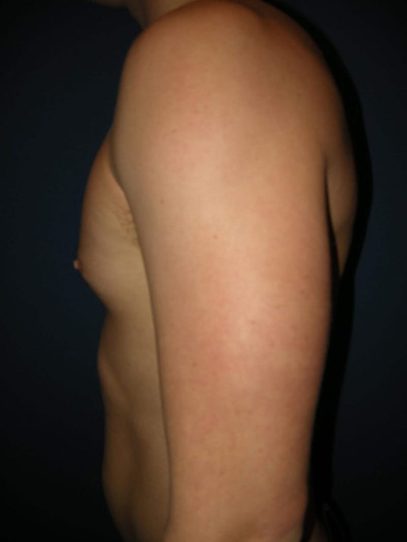 Gynecomastia by Dr. Haydon Before & After Gallery - Patient 55455232 - Image 4