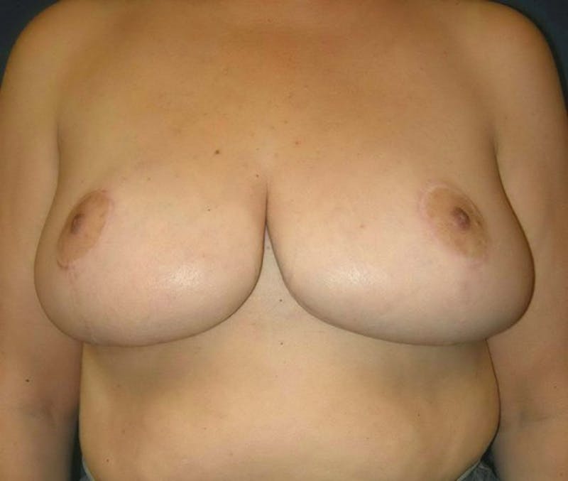 Breast Reduction by Dr. Haydon Before & After Gallery - Patient 55455235 - Image 2