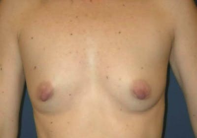 Breast Augmentation by Dr. Haydon Before & After Gallery - Patient 55455236 - Image 1
