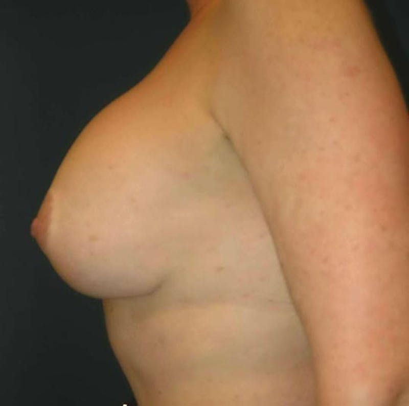 Breast Revision by Dr. Haydon Before & After Gallery - Patient 55455234 - Image 5