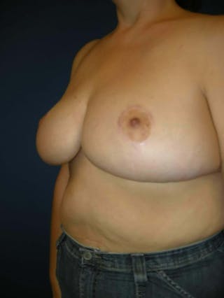 Breast Reduction by Dr. Haydon Before & After Gallery - Patient 55455235 - Image 4