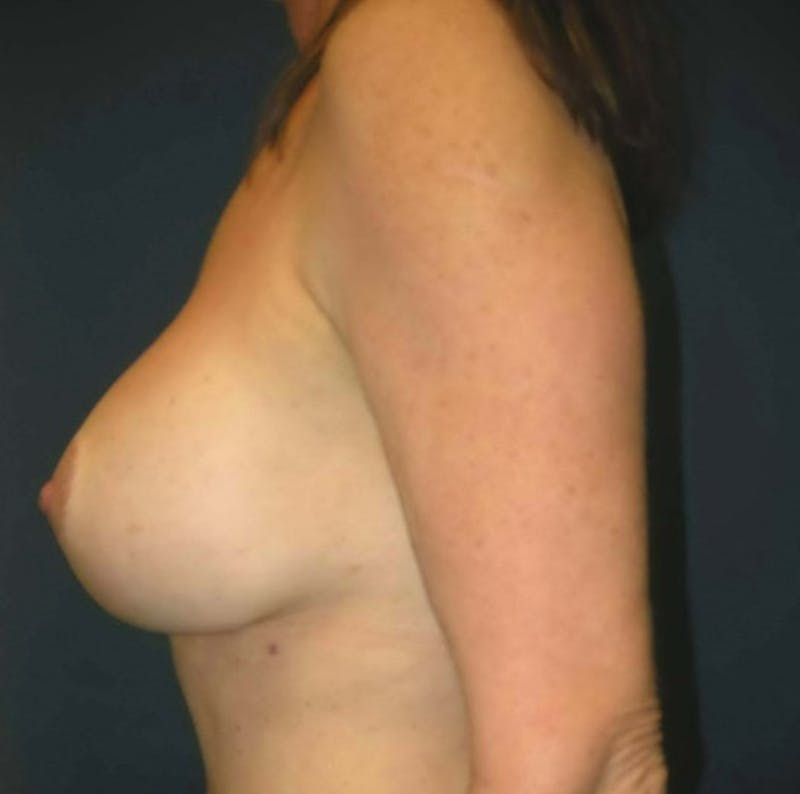 Breast Revision by Dr. Haydon Gallery - Patient 55455234 - Image 6