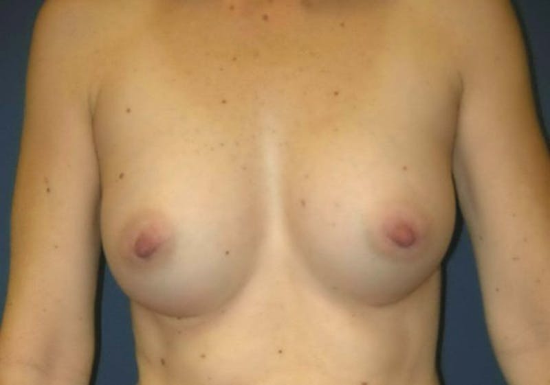 Breast Augmentation by Dr. Haydon Before & After Gallery - Patient 55455236 - Image 2