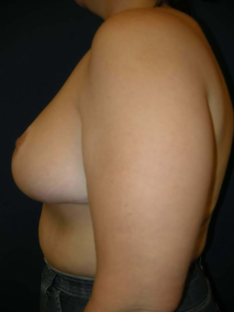 Breast Reduction by Dr. Haydon Before & After Gallery - Patient 55455235 - Image 6
