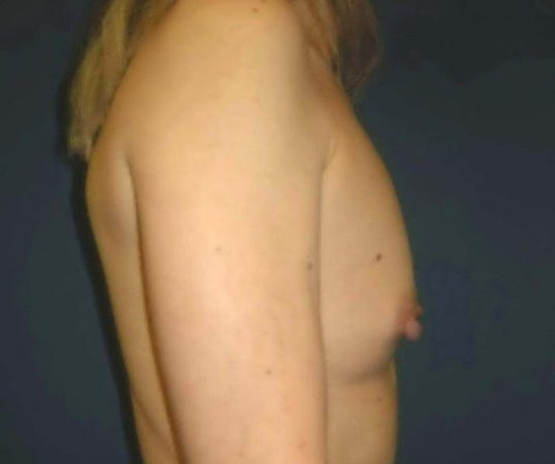 Breast Augmentation by Dr. Haydon Before & After Gallery - Patient 55455236 - Image 3