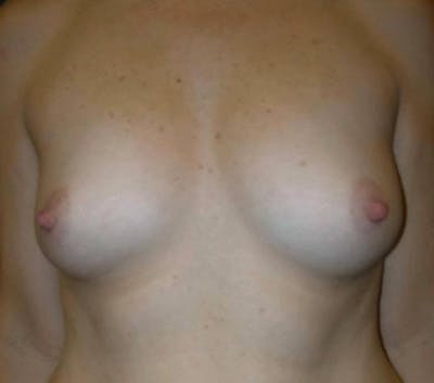Breast Augmentation by Dr. Haydon Before & After Gallery - Patient 55455238 - Image 1