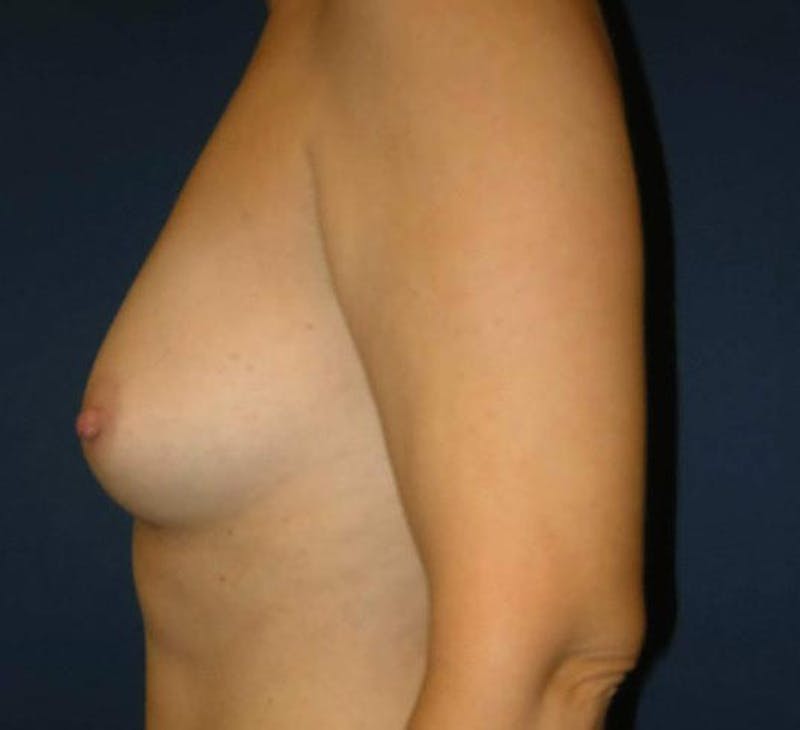 Breast Augmentation by Dr. Haydon Before & After Gallery - Patient 55455238 - Image 3
