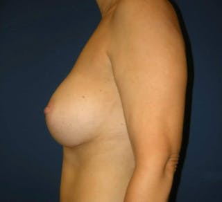 Breast Augmentation by Dr. Haydon Before & After Gallery - Patient 55455238 - Image 4