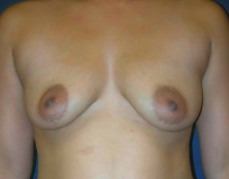Breast Augmentation by Dr. Haydon Before & After Gallery - Patient 55455239 - Image 1