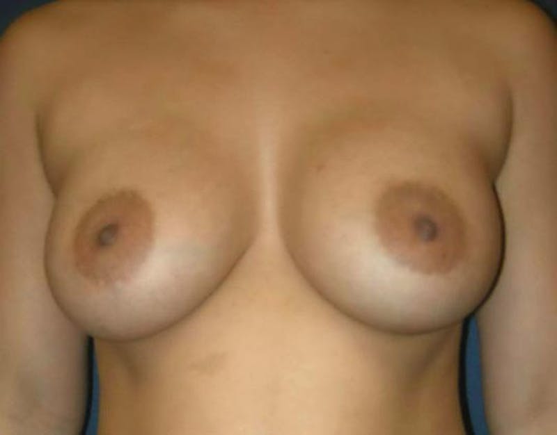 Breast Augmentation by Dr. Haydon Before & After Gallery - Patient 55455239 - Image 2