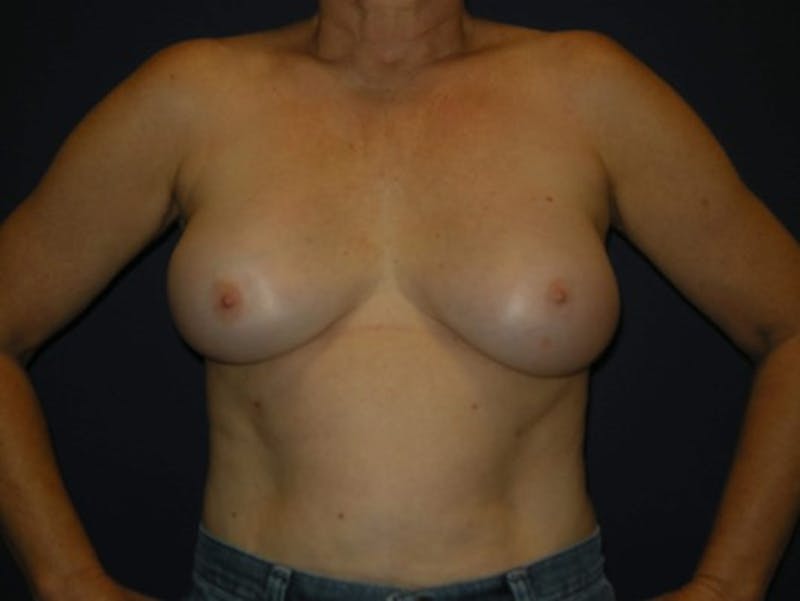 Breast Augmentation by Dr. Haydon Before & After Gallery - Patient 55455244 - Image 2