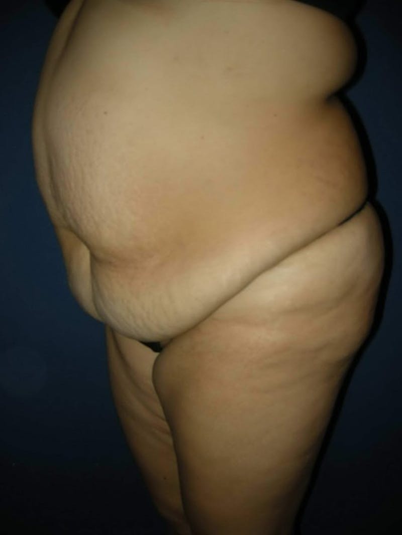 Liposuction by Dr. Haydon Before & After Gallery - Patient 55455249 - Image 3