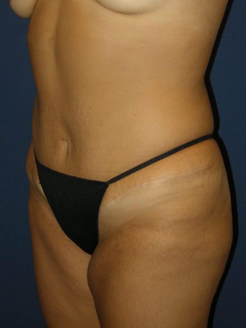 Liposuction by Dr. Haydon Before & After Gallery - Patient 55455249 - Image 4