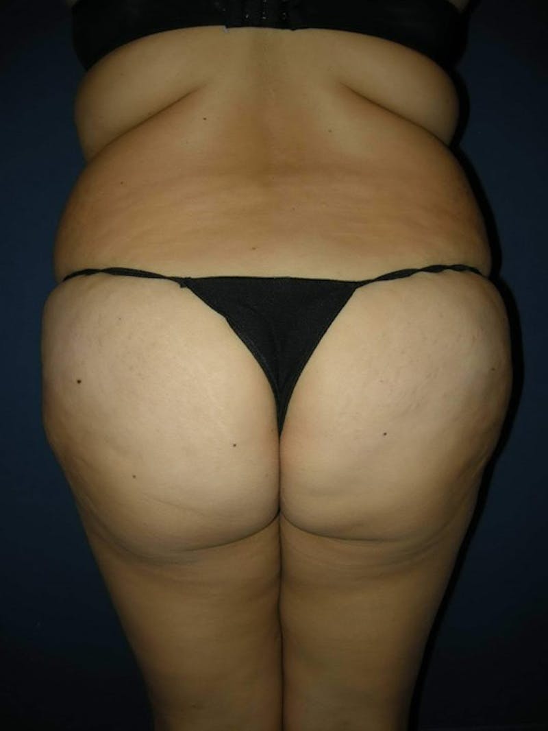 Liposuction by Dr. Haydon Before & After Gallery - Patient 55455249 - Image 5