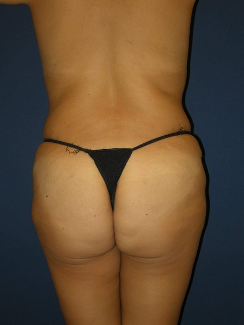 Liposuction by Dr. Haydon Before & After Gallery - Patient 55455249 - Image 6