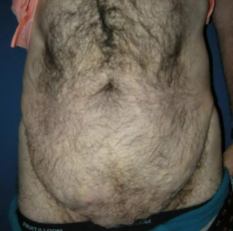Liposuction by Dr. Haydon Before & After Gallery - Patient 55455252 - Image 1