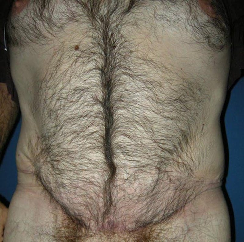 Liposuction by Dr. Haydon Before & After Gallery - Patient 55455252 - Image 2