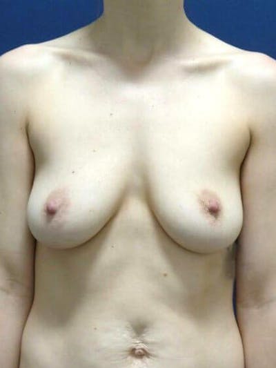 Breast Augmentation by Dr. Haydon Before & After Gallery - Patient 55455254 - Image 1