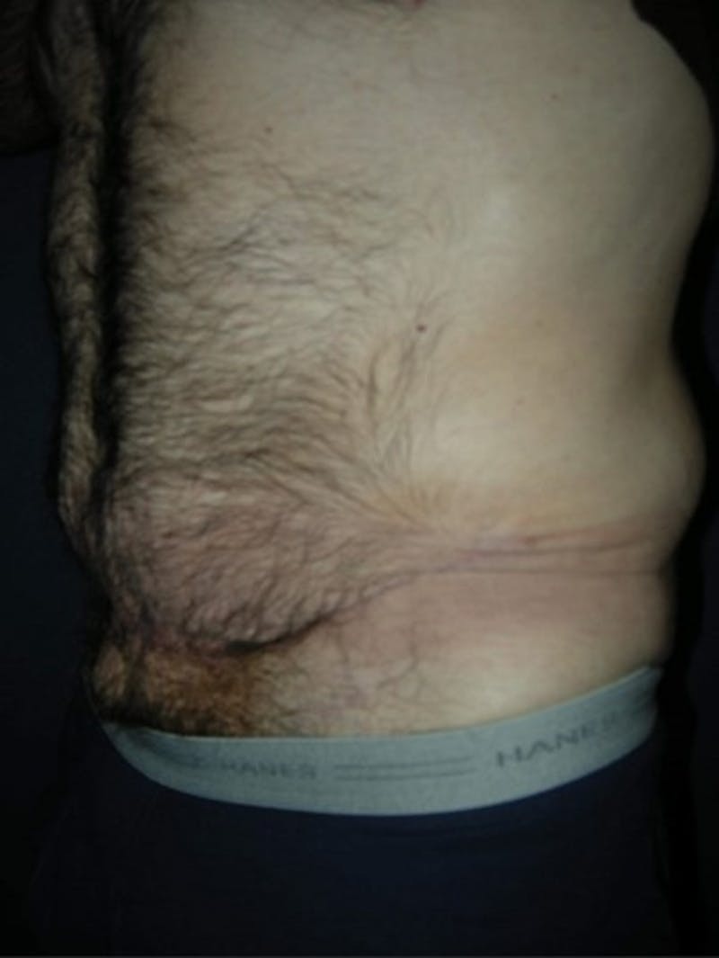 Liposuction by Dr. Haydon Gallery - Patient 55455252 - Image 4