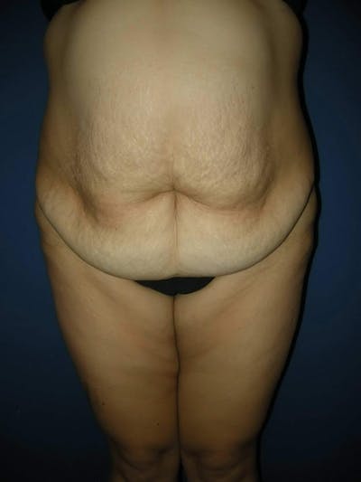 After Weight Loss Surgery by Dr. Haydon Before & After Gallery - Patient 55455255 - Image 1