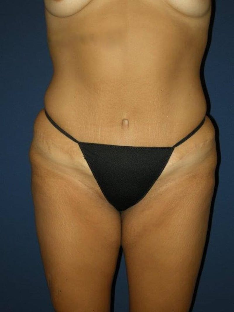 After Weight Loss Surgery by Dr. Haydon Gallery - Patient 55455255 - Image 2