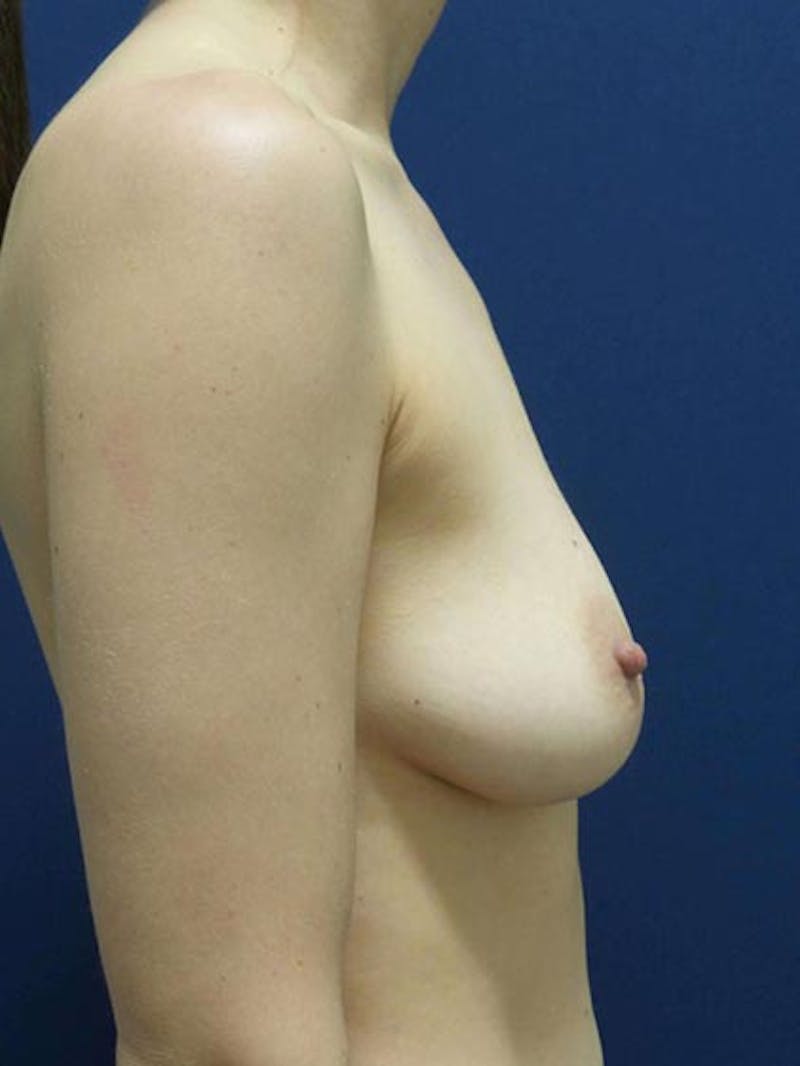 Breast Augmentation by Dr. Haydon Before & After Gallery - Patient 55455254 - Image 5