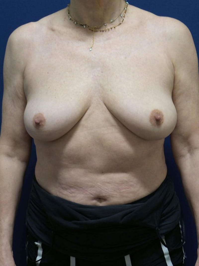Breast Augmentation by Dr. Haydon Before & After Gallery - Patient 55455262 - Image 1