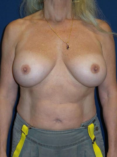 Breast Augmentation by Dr. Haydon Before & After Gallery - Patient 55455262 - Image 2