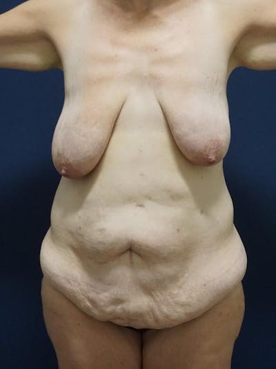Liposuction by Dr. Haydon Before & After Gallery - Patient 55455264 - Image 1