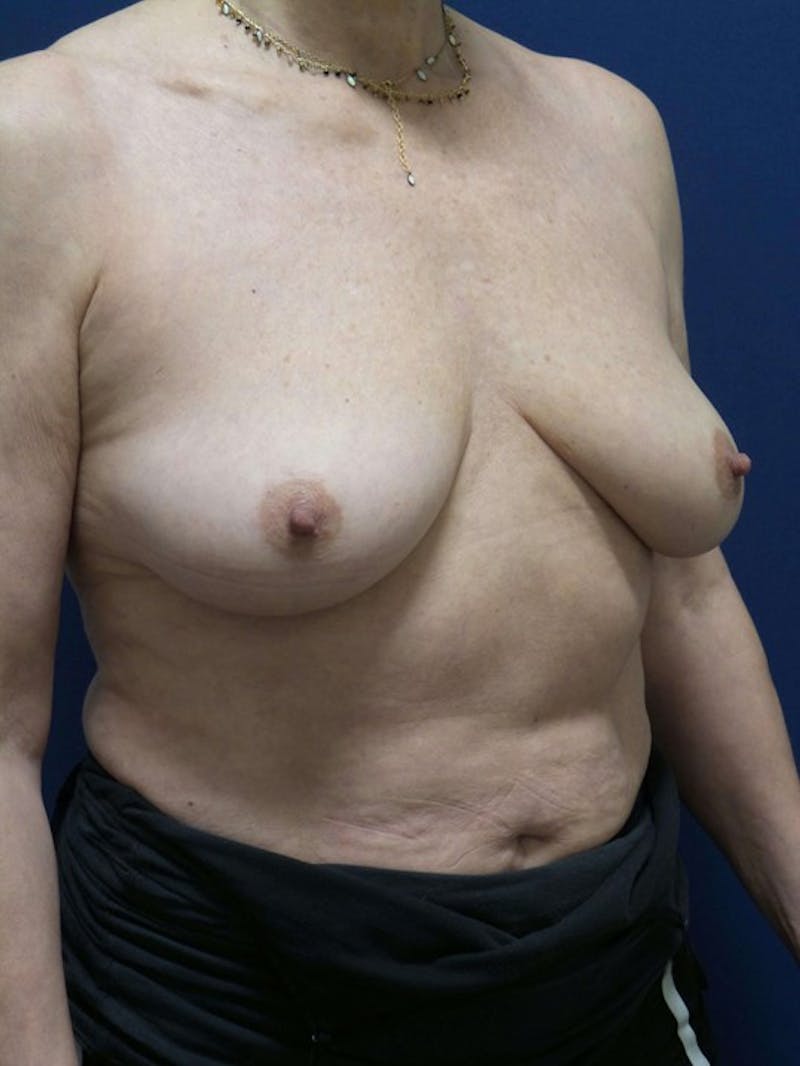 Breast Augmentation by Dr. Haydon Before & After Gallery - Patient 55455262 - Image 3