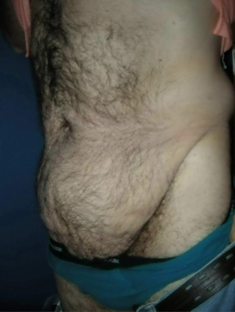 After Weight Loss Surgery by Dr. Haydon Before & After Gallery - Patient 55455260 - Image 3